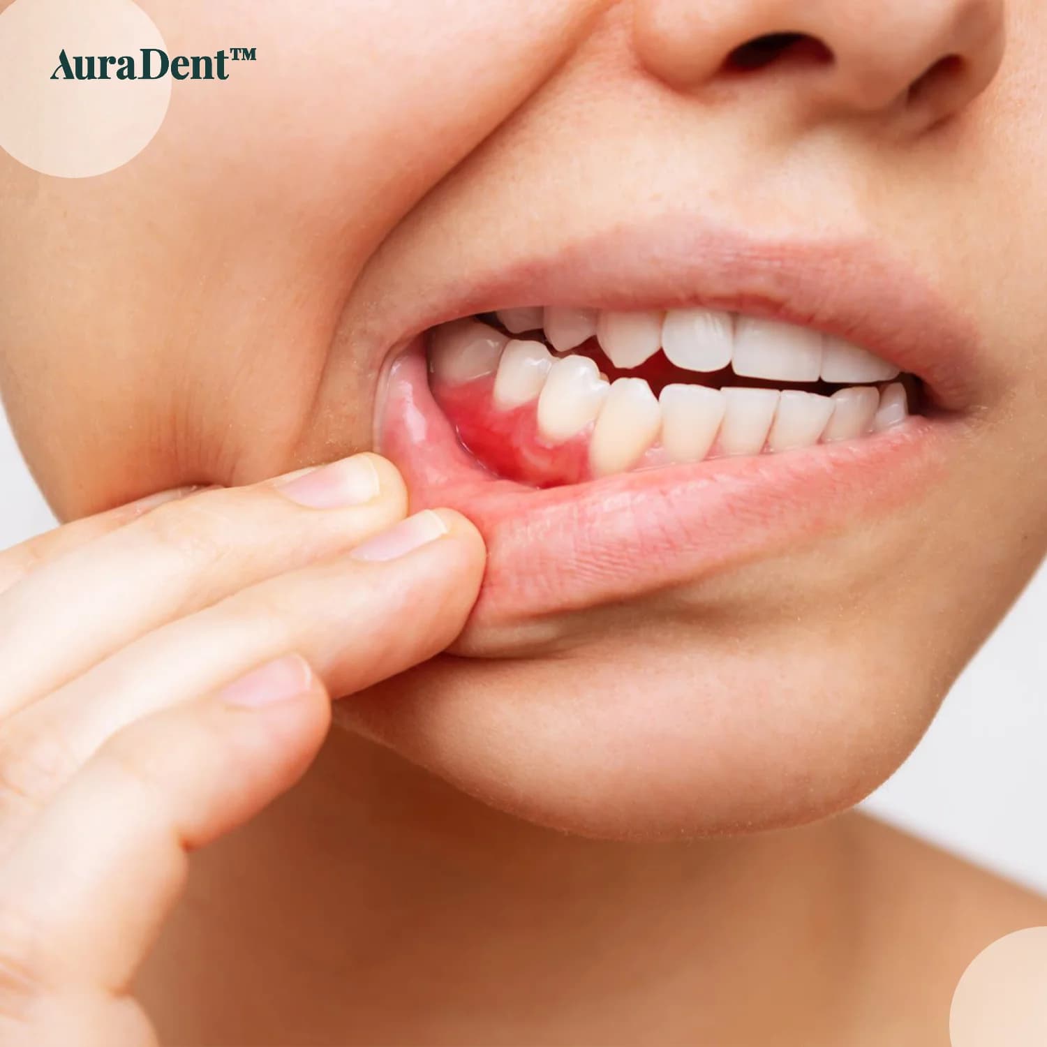 Infektion i tandköttet: orsaker, förebyggande åtgärder och samband med ortodontisk behandling