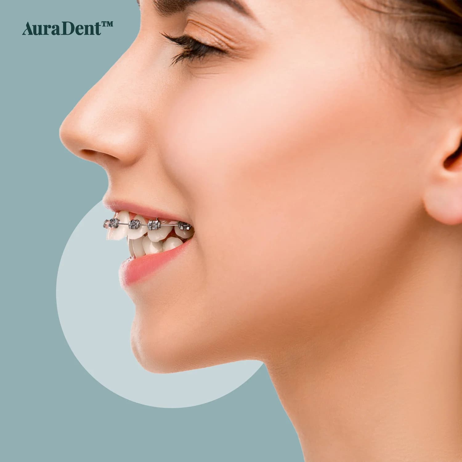 Överbett: Vad innebär det, vem kan påverkas och på vilket sätt kan ortodontisk behandling vara till hjälp?