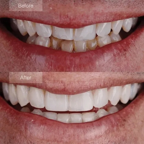 Invisalign-before-after